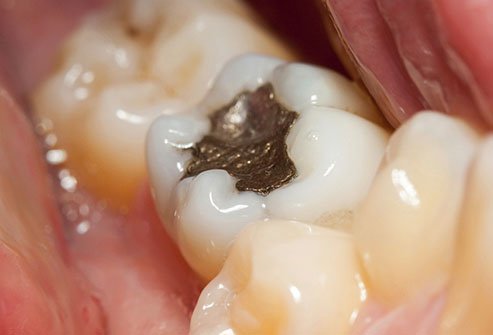 Dental fillings can become a popular breeding ground for bacteria.