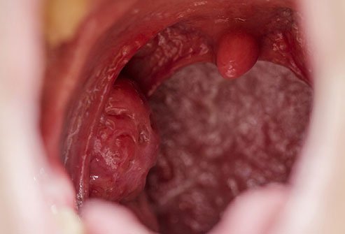 Tonsil stones can stink up your throat.