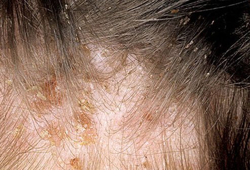 Treatment is recommended for anyone with an active infestation of head lice.