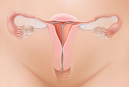 IUD