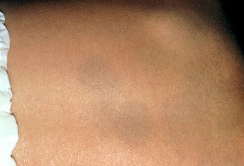 Mongolian spots are bluish-grey discolorations that can only be appreciated visually, since you cannot feel them.