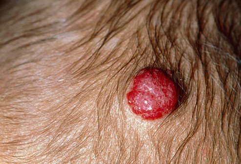 Hemangiomas are tumors of blood vessels that are often present soon after birth.