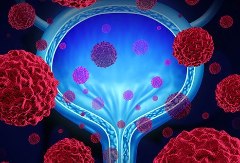 The survival rate depends on the stage of cancer at diagnosis and other health issues. The survival rate depends on the stage of cancer at diagnosis and other health issues.