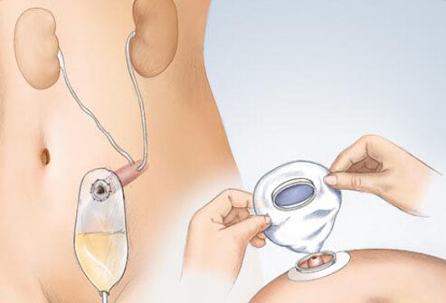 The use of a bladder catheter is common among bladder cancer patients.