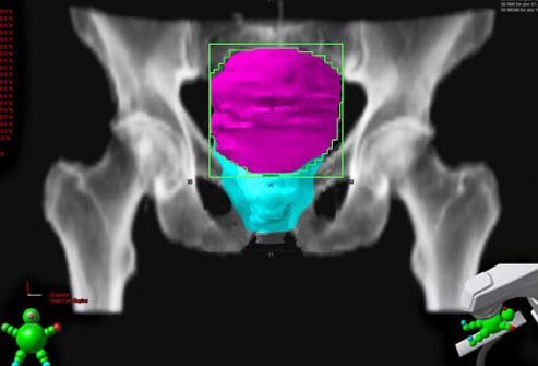 Pelvic radiotherapy for bladder cancer.