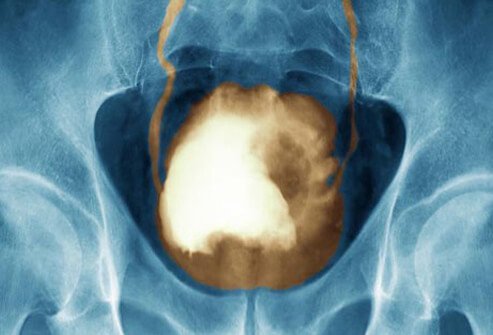Bladder cancer sometimes causes changes in bladder habits like having to urinate more often or feeling an urgent need to urinate without producing urine.