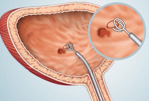 Cystoscopy is a bladder cancer diagnostic test. 