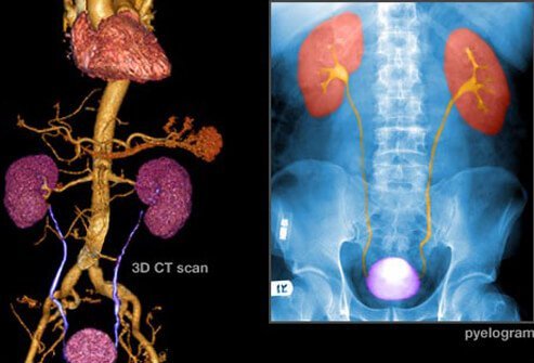 A CT scan and pyelogram of bladder cancer.