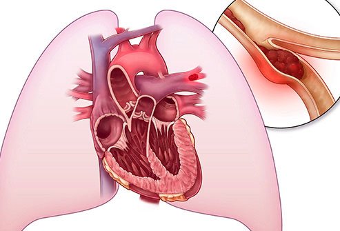 A clot can give you different symptoms based on where it is.