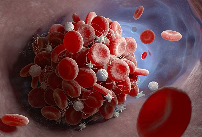 What Is the Difference Between Critical Limb Ischemia and Acute Limb Ischemia