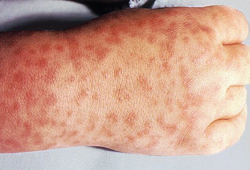 Ticks can spread Rocky Mountain fever, which can lead to widespread pain.