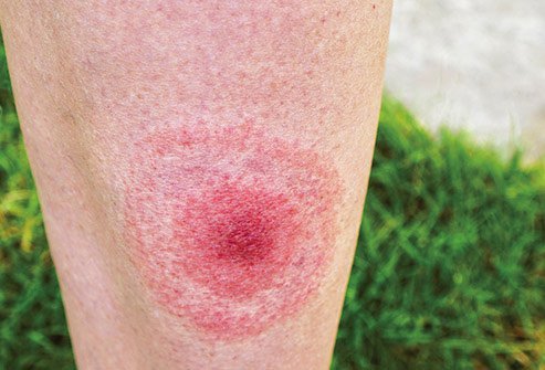 Lyme disease can cause joints to swell, causing intense pain.