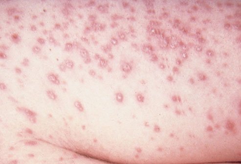 People may become infected with Histoplasma by inhaling airborne fungal spores.