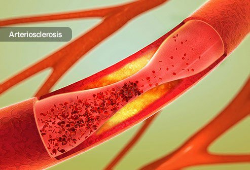 Claudication can make your legs ache and burn.