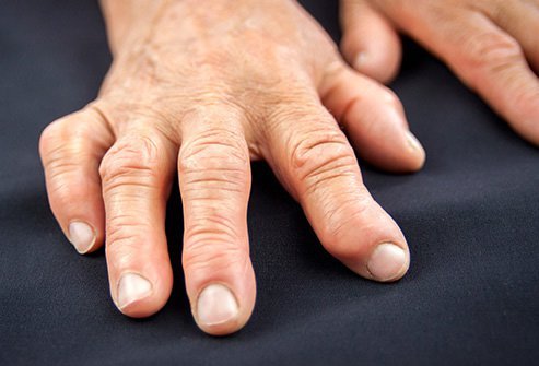 The stiffness and swelling of arthritis causes body pain.