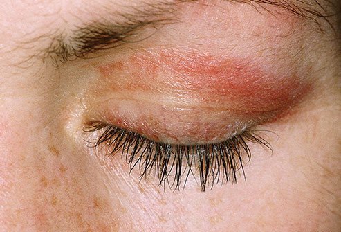 Eyelid rashes are a symptom of dermatomyositis, an autoimmune disease.