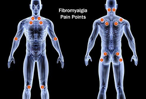 Fibromyalgia causes widespread pain all over the body.