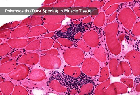 Polymyositis causes pain by making your immune system attack muscle fibers.