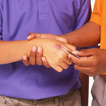 A person uses tweezers to pull a foreign object from another person's hand.
