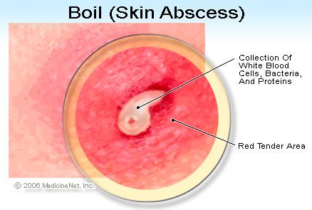 Picture of a Boil (Skin Abscess)
