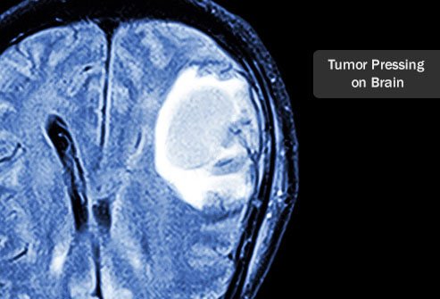 Brain Tumor