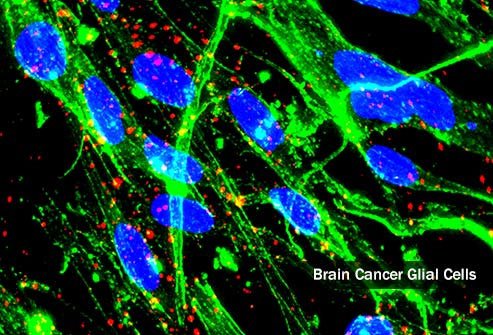 Primary brain tumors begin in the brain cells.