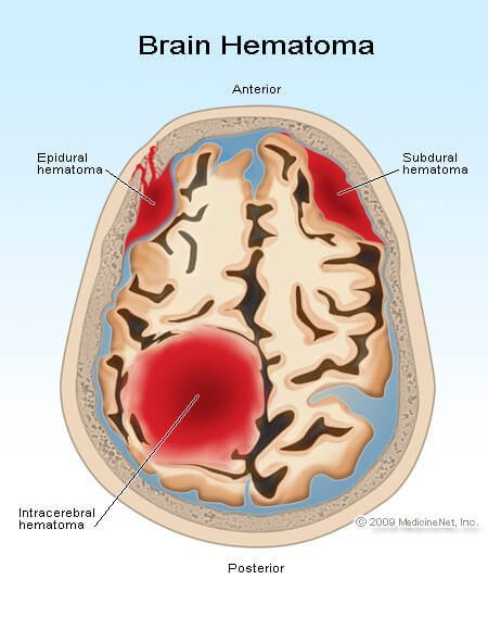 Picture of epidural, subdural, and intracerebral hematomas.