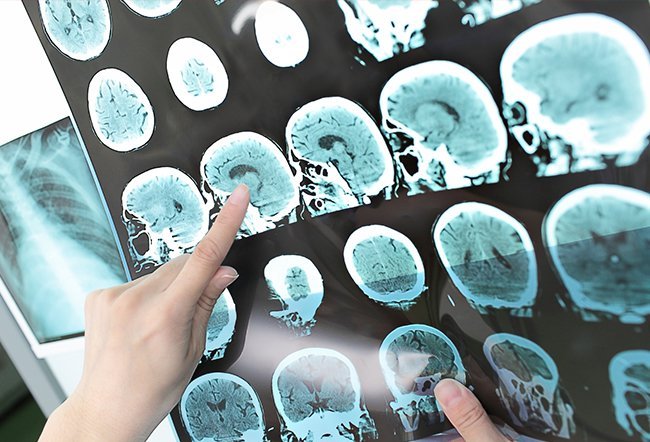 schwannoma schwannoma