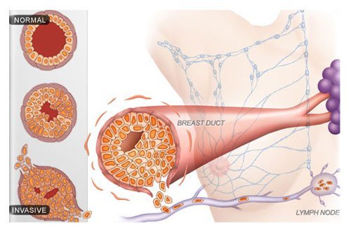 Breast cancer stages are classified according to cancer tumor size, location, and extent of spread. Staging helps doctors determine the prognosis and treatment for cancer. 