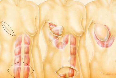 Breast cancer reconstruction surgery. 