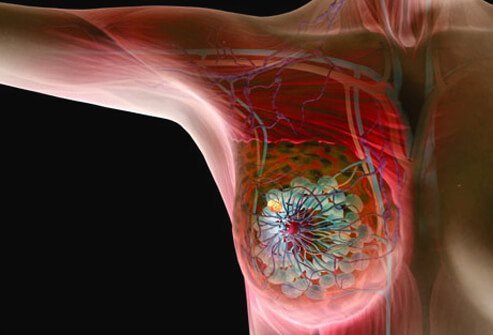 Picture of Breast Cancer Symptoms