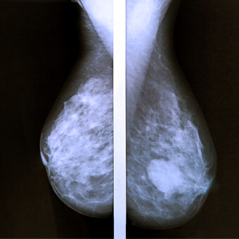 Breast cancer is a malignant tumor that forms in the breast.