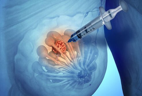Needle biopsies are used to diagnose breast cancer. 