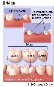 Picture of a dental bridge