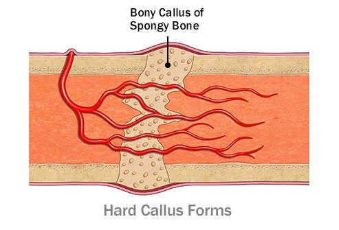 A hard callus is spongy bone that forms in the space between broken pieces of bone. 