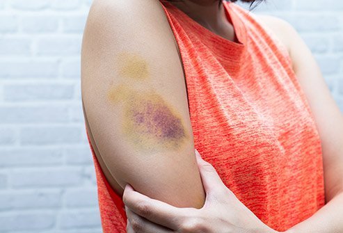 Thrombosis with Thrombocytopenia Syndrome