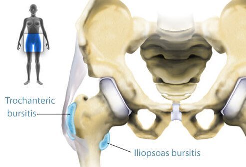 Hip bursitis occurs as a result of inflammation of one of two bursae located around the hip.