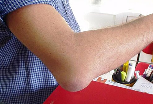 Elbow bursitis is inflammation of the bursa covering the pointy part of the elbow called the olecranon.