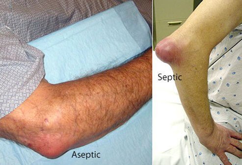 Septic bursitis refers to inflammation of the bursa caused by an infection.