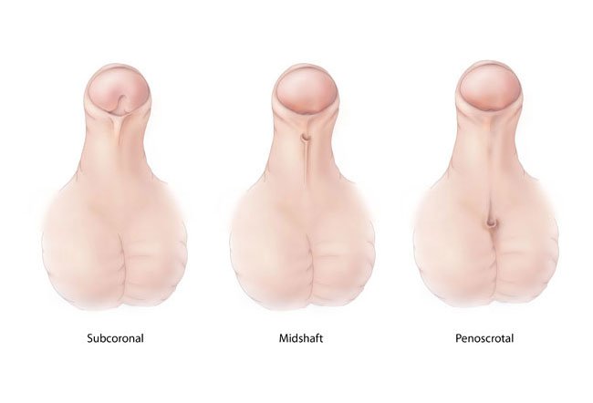 hypospadias