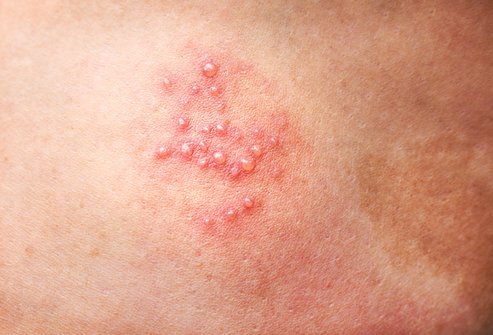 The severity of shingles depends on various factors The severity of shingles depends on various factors