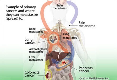 Illustration showing the examples of primary cancers and locations to which they can metastasize (spread).