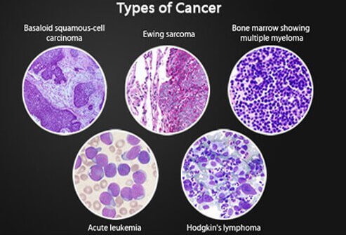 Micrographs of squamous-cell carcinoma, Ewing sarcoma, multiple myeloma, acute leukemia, and Hodgkin's lymphoma.