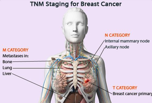 Tumor, Node, Metastasis (TNM) staging for breast cancer.
