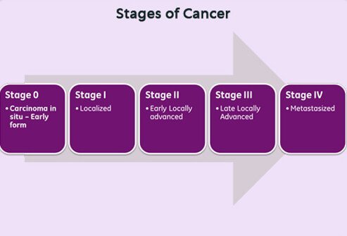 Chart illustrating the 5 stages of cancer.