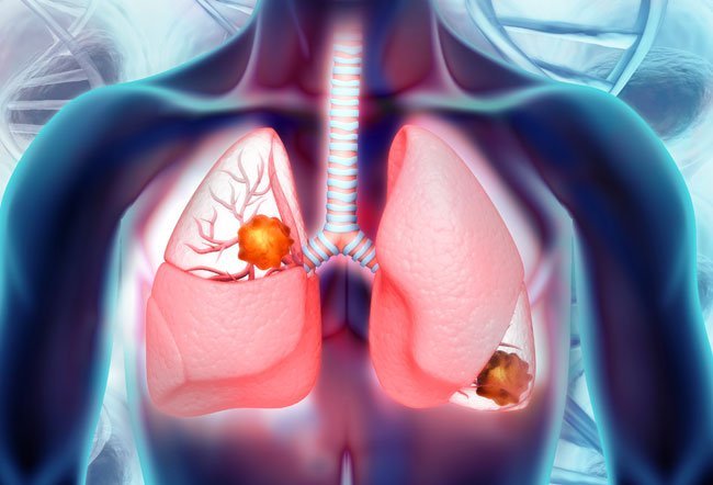 Multiple nodules in the lungs or multiple pulmonary nodules (MPN) refer to two or more lesions in the lungs. 