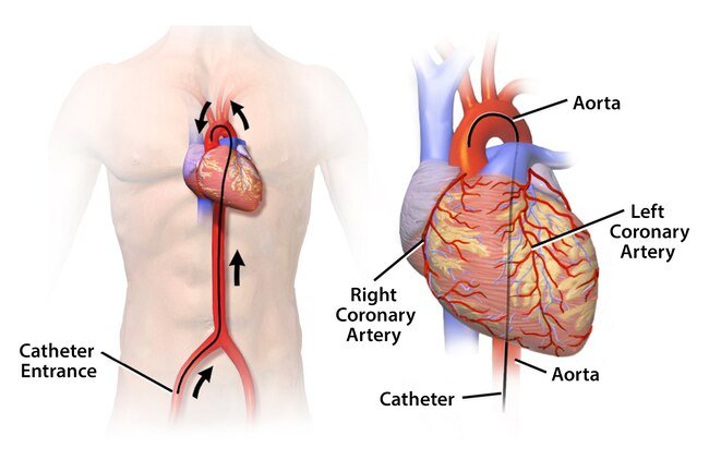 Your doctor may put a soft, thin tube called a catheter into a blood vessel in your neck, arm, or upper thigh and guide it to your heart.