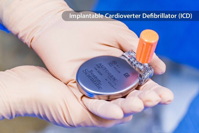 This device is a small automated defibrillator that a surgeon can implant under your skin to send an electric shock to your heart if it finds certain irregular heartbeats.
