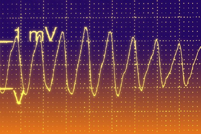 Your heart has an electrical system that keeps it beating regularly.