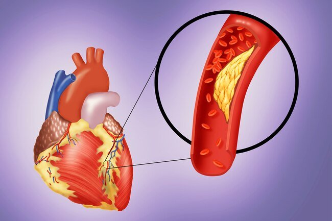 Many people who have cardiac arrest also have coronary artery disease.